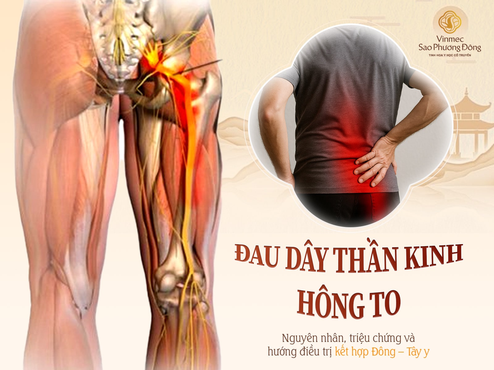 Đau dây thần kinh hông to: Nguyên nhân, triệu chứng và hướng điều trị kết hợp Đông – Tây y